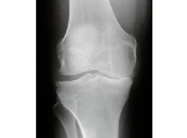 Diagnose einer Arthrose des Kniegelenks