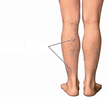 Die Folgen der Knie -Arthrose