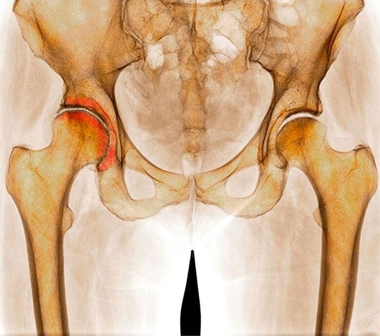 Hüftgelenk -Osteoarthritis