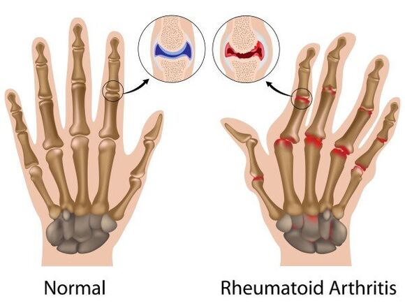 Finger ohne Pathologie und rheumatoide Arthritis