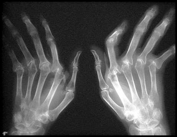 X -Strahl der Hände, die von Arthrose betroffen sind