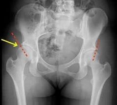 Methoden zur Behandlung der Arthrose des Hüftgelenks
