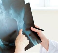 Wie man die Arthrose des Hüftgelenks behandelt