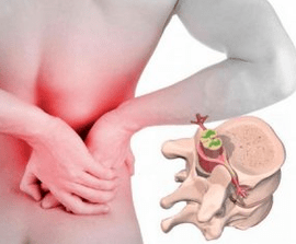 Lumbago zu Beginn der Osteochondrose der Krankheit
