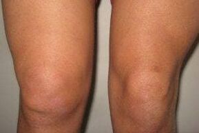 Entzündung im Kniegelenk mit Arthritis und Arthrose.