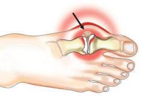Gelenkschäden durch Arthritis und Arthrose.