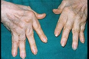 Symptome einer Fingerarthritis
