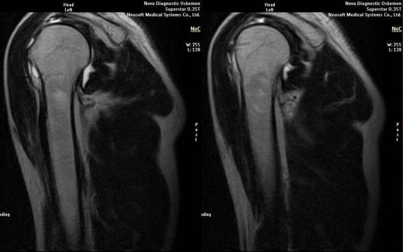 Arthrose des Schultergelenks im Röntgenbild