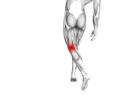 Arthrose des Kniegelenks.