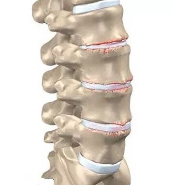 Osteochondrose